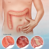 Inflammatory bowel disease
